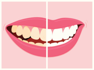 Tooth Whitening