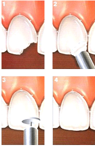 composite bonding for cracked teeth in NYC