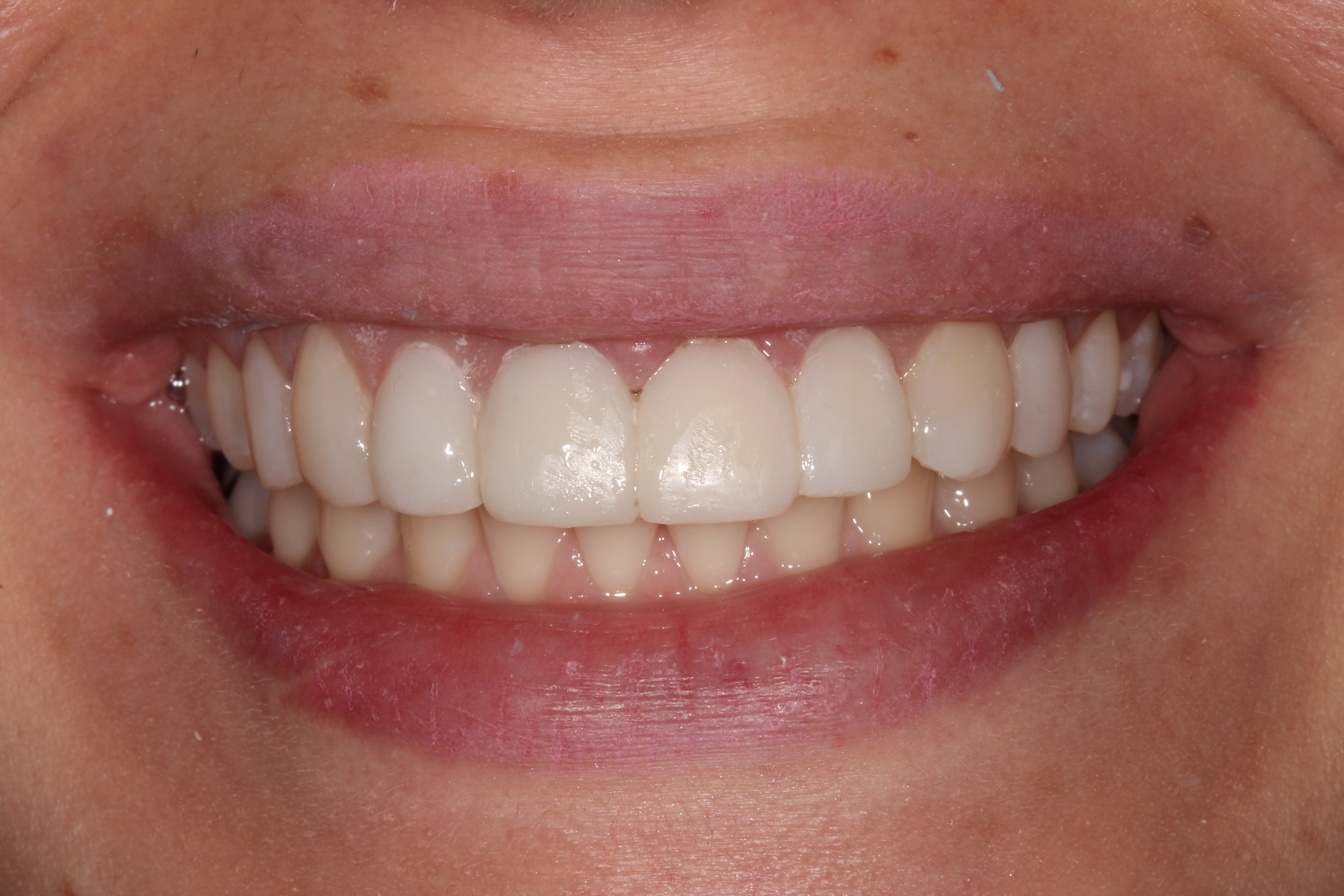 Porcelain Veneers in New York City Dental Services NYCCD