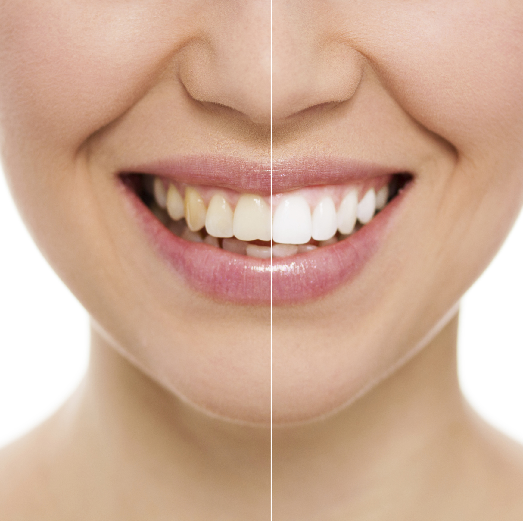 Composite Bonding For Teeth - Dental Treatments