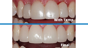 veneers and crowns before and after
