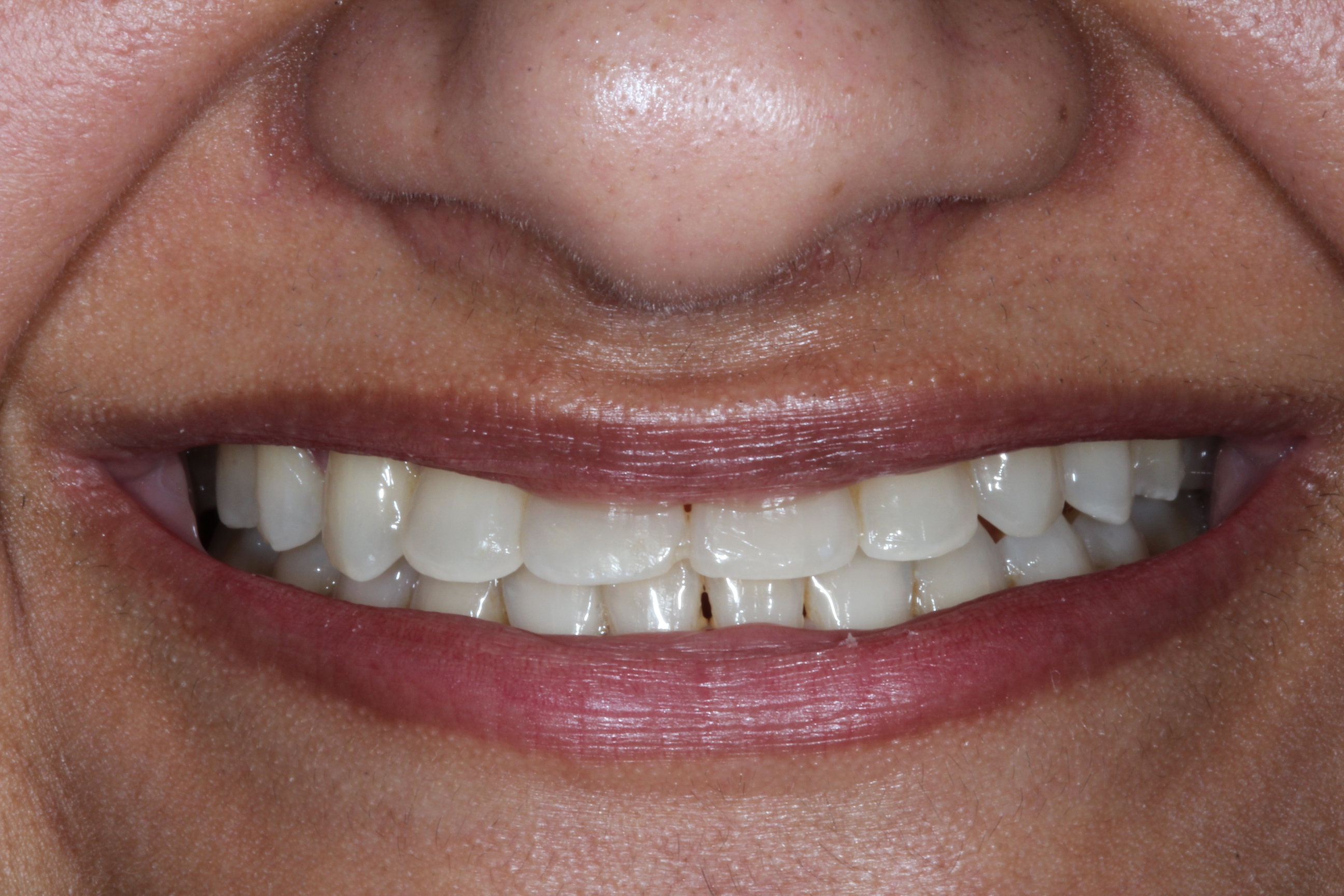 Porcelain Veneers in New York City Dental Services NYCCD