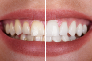 Teeth Whitening Dentist NYC