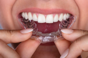 invisalign