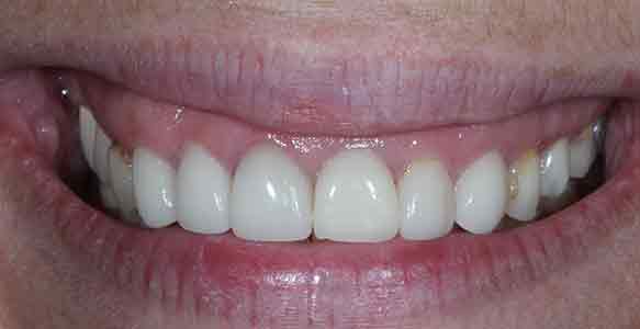 case16b