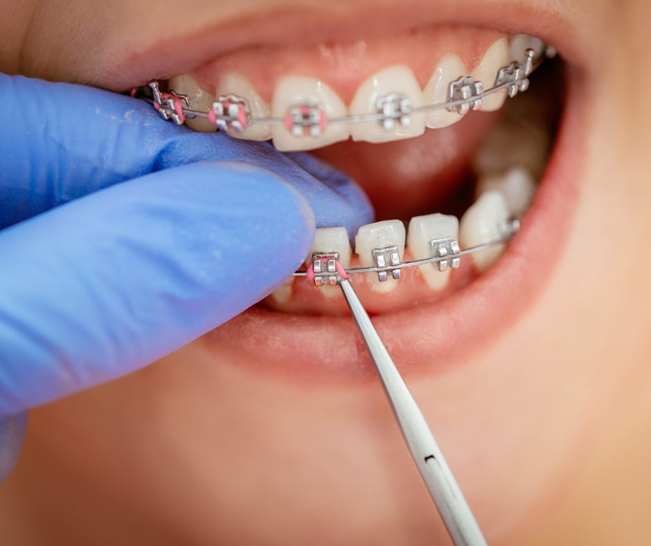 NYCCD braces