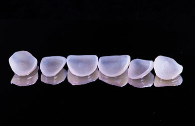 Porcelain Veneers 1