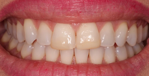 Veneers case 28 a