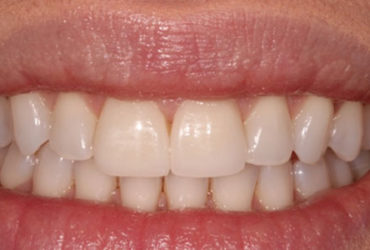 Veneers case 28 b