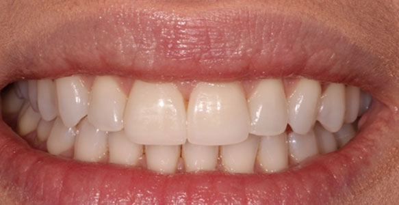 Veneers case 28 b