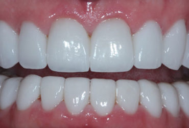 Veneers case 29 a