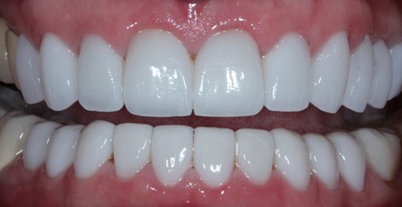 Veneers case 29 a