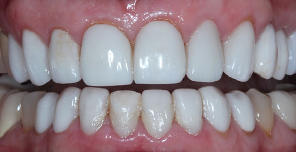 Veneers case 29 b