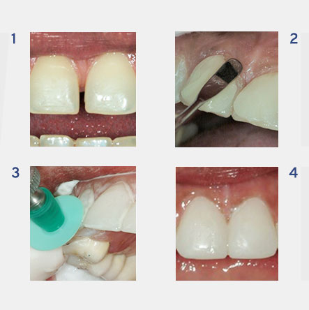 nyc cosmetic dentistry teeth bonding 