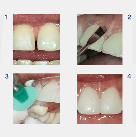 Top 5 reasons to consider cosmetic composite bonding