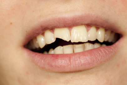chipped tooth of a person
