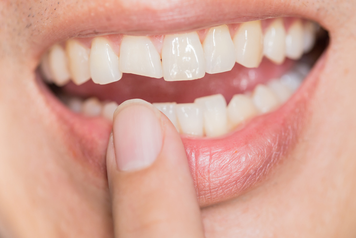 man pointing at his chipped tooth