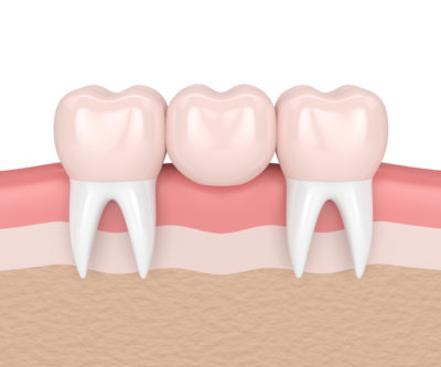 porcelain dental bridges