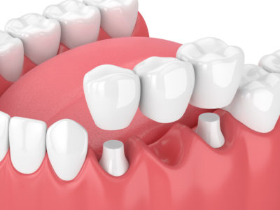 porcelain dental bridges