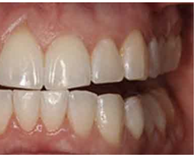 Cosmetic dentistry - teeth whitening after
