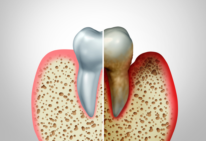 how to prevent periodontal disease 