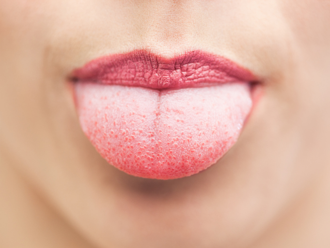 What is a white tongue?