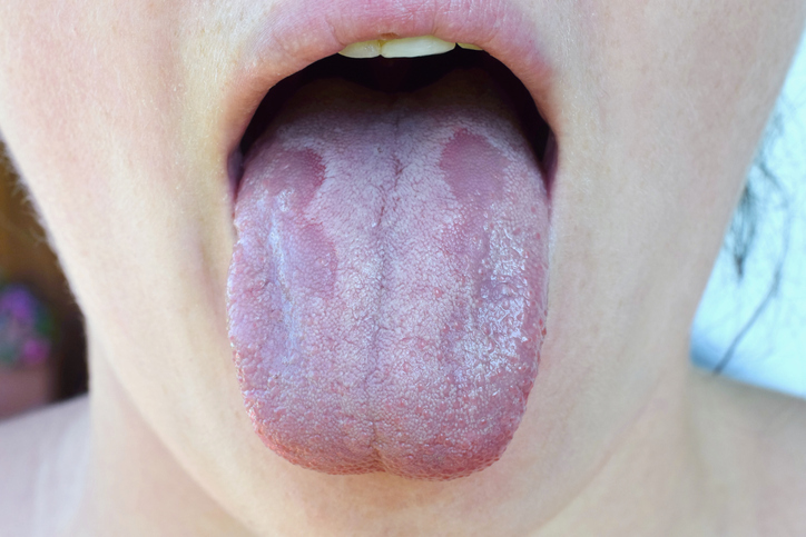 What causes a white tongue 